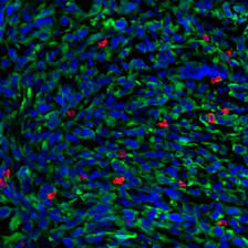 immunofluorescent image of a tumor stained for t cells