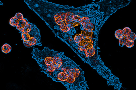 human macrophages (blue) engulf tumor cells (orange) that have been flagged with therapeutic antibody