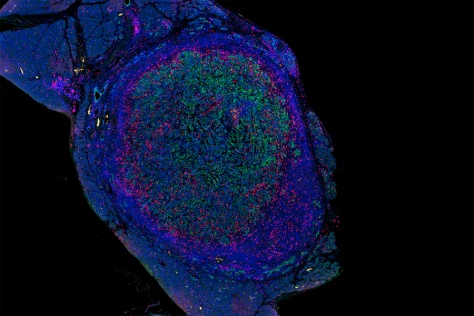 pancreatic tumor with T cells that have infiltrated tumor cells after treatment with a combination immunotherapy