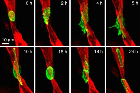 metastasizing cancer cells