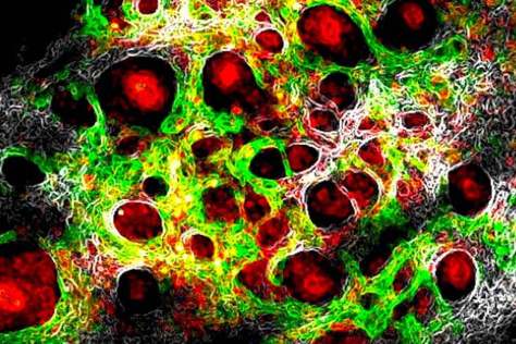 melanoma cells