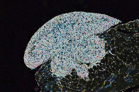 immunohistochemical image of an ovarian tumor