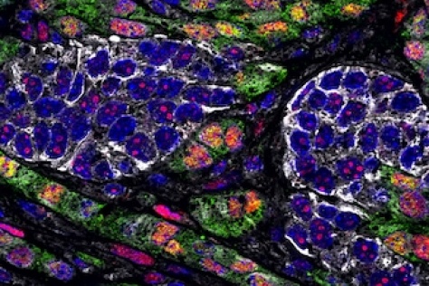 Epithelial cancer cells (in white) and quasi-mesenchymal cancer cells (in green)