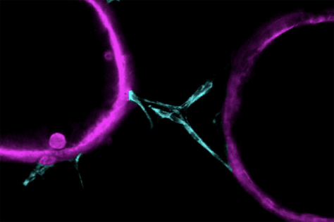 3D pancreatic cancer organoids interacting with non-cancer cells