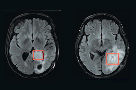 scans of two brains with tumors