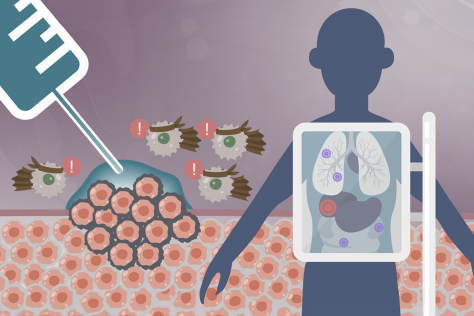 illustration person with an x-ray machine showing the insides of a the torso, with several tumors. Behind, a needle injects a tumor full of gel, attracting immune cells